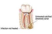 EndodonticRetreatment